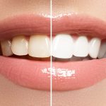 natural teeth whitening