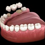 how long does a dental bridge last