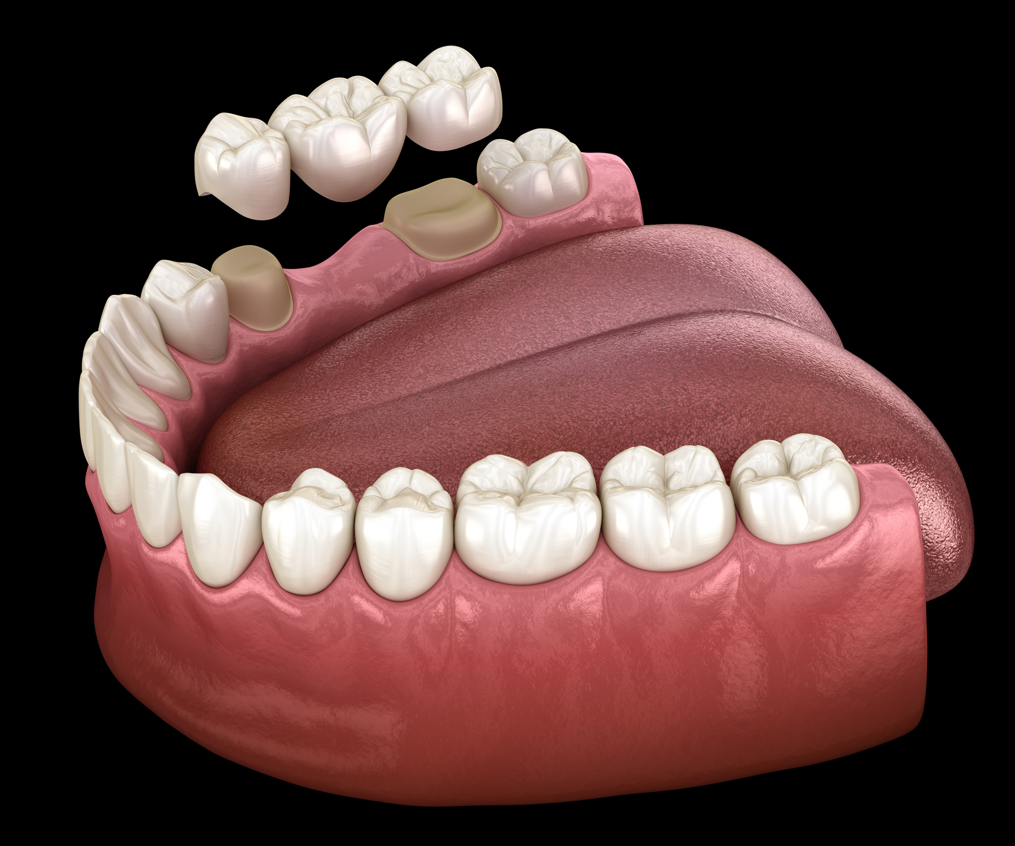 how-long-does-a-dental-bridge-last-luz-dds-wesley-chapel-fl